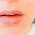 Herpes Labial