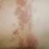 Herpes Zoster
