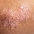Psoriasis