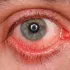 Ojo rojo e irritado