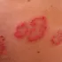 Picor de piel y dermatitis