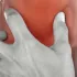 Laringitis