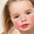 Dermatitis atópica