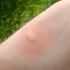 Picadura de mosquitos