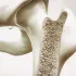 Osteoporosis